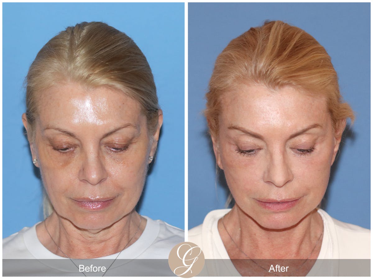 Preservation Facelift Before & After Gallery - Patient 306280 - Image 3