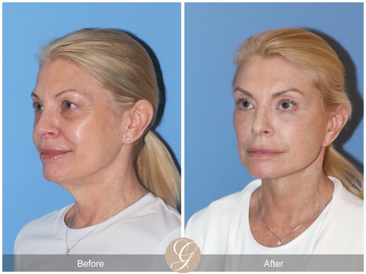 Preservation Facelift Before & After Gallery - Patient 306280 - Image 7