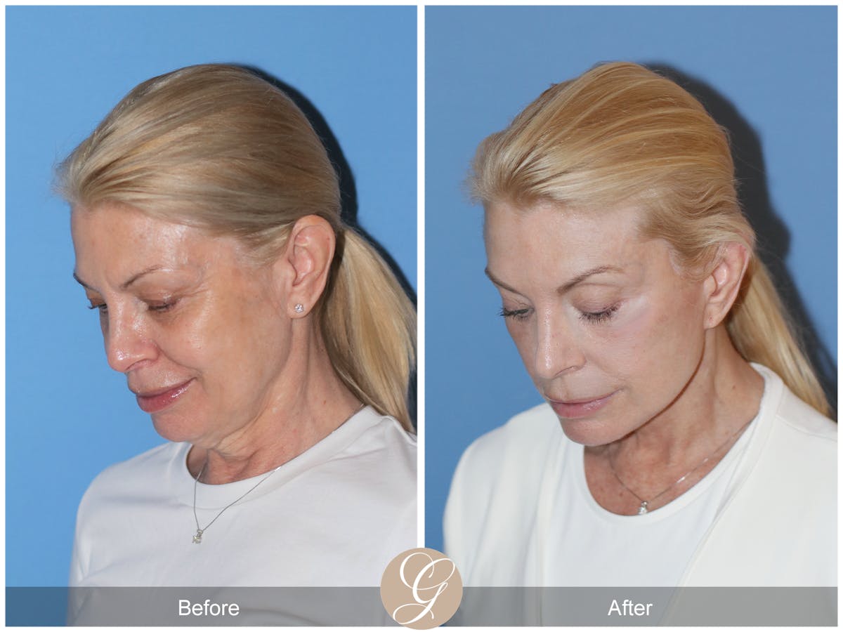 Preservation Facelift Before & After Gallery - Patient 306280 - Image 8