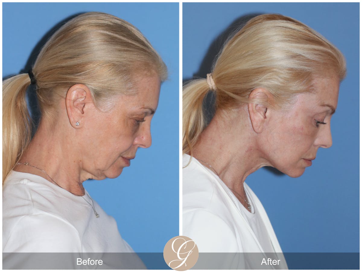 Preservation Facelift Before & After Gallery - Patient 306280 - Image 6