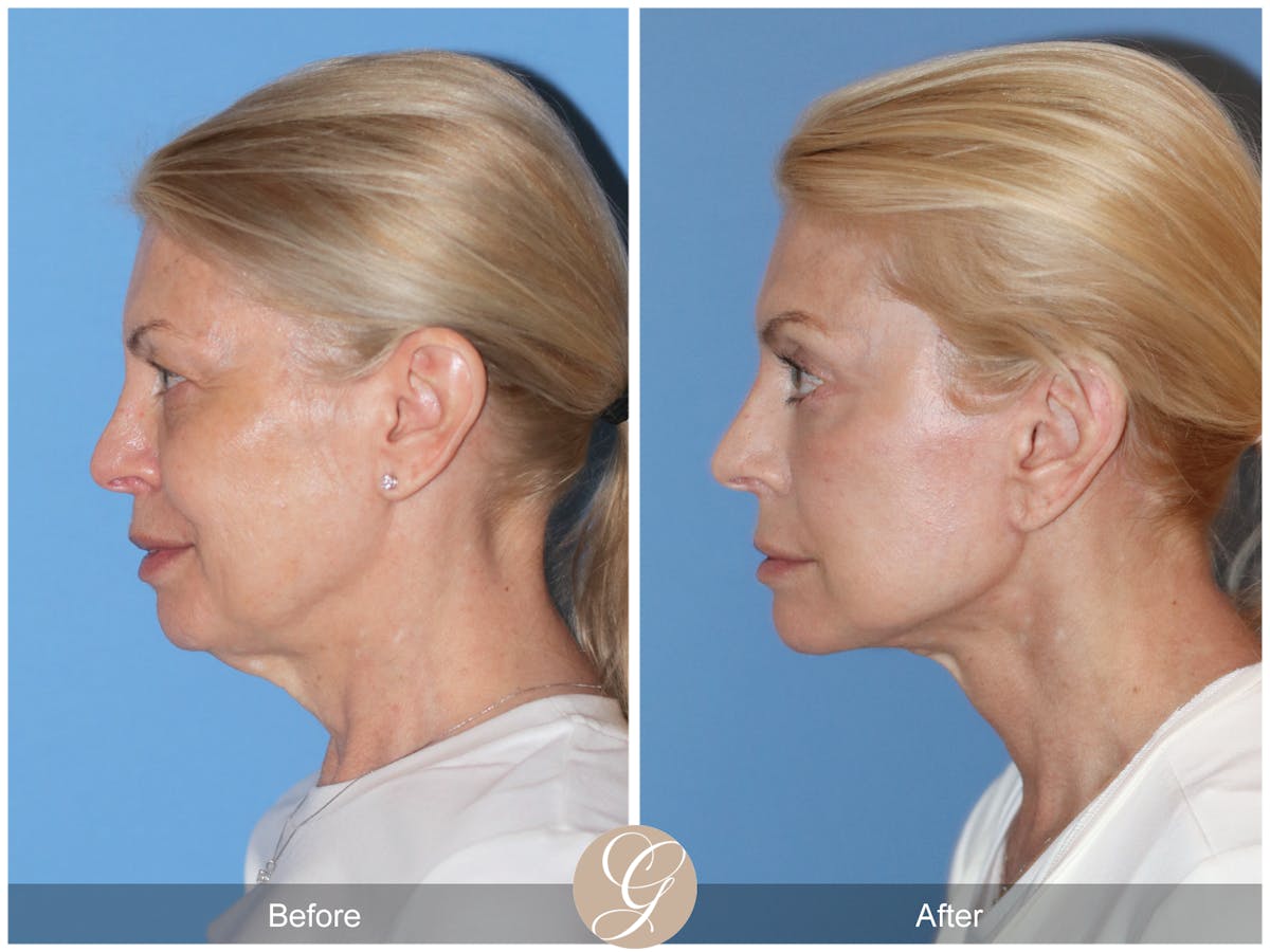 Preservation Facelift Before & After Gallery - Patient 306280 - Image 9
