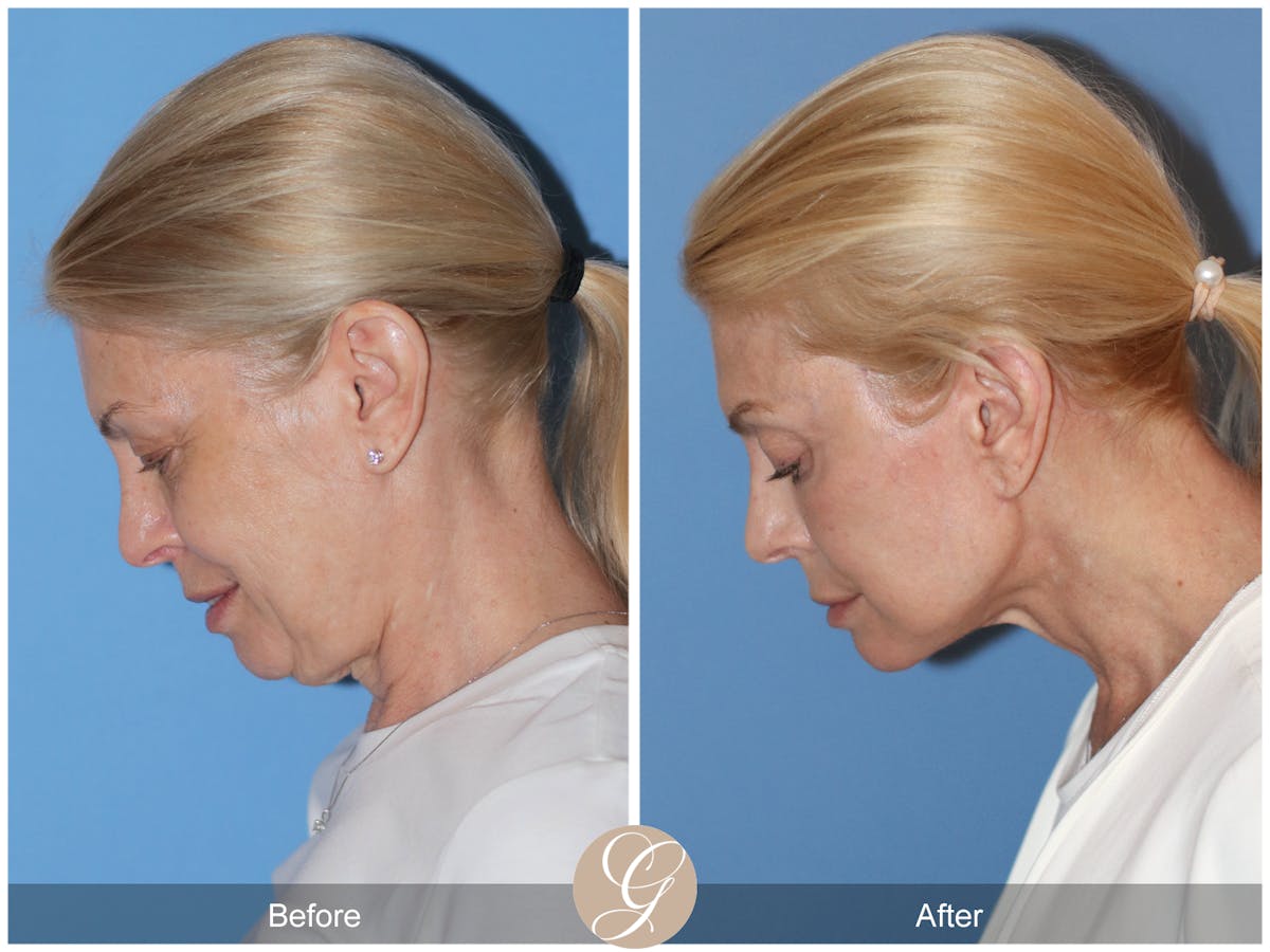 Preservation Facelift Before & After Gallery - Patient 306280 - Image 10
