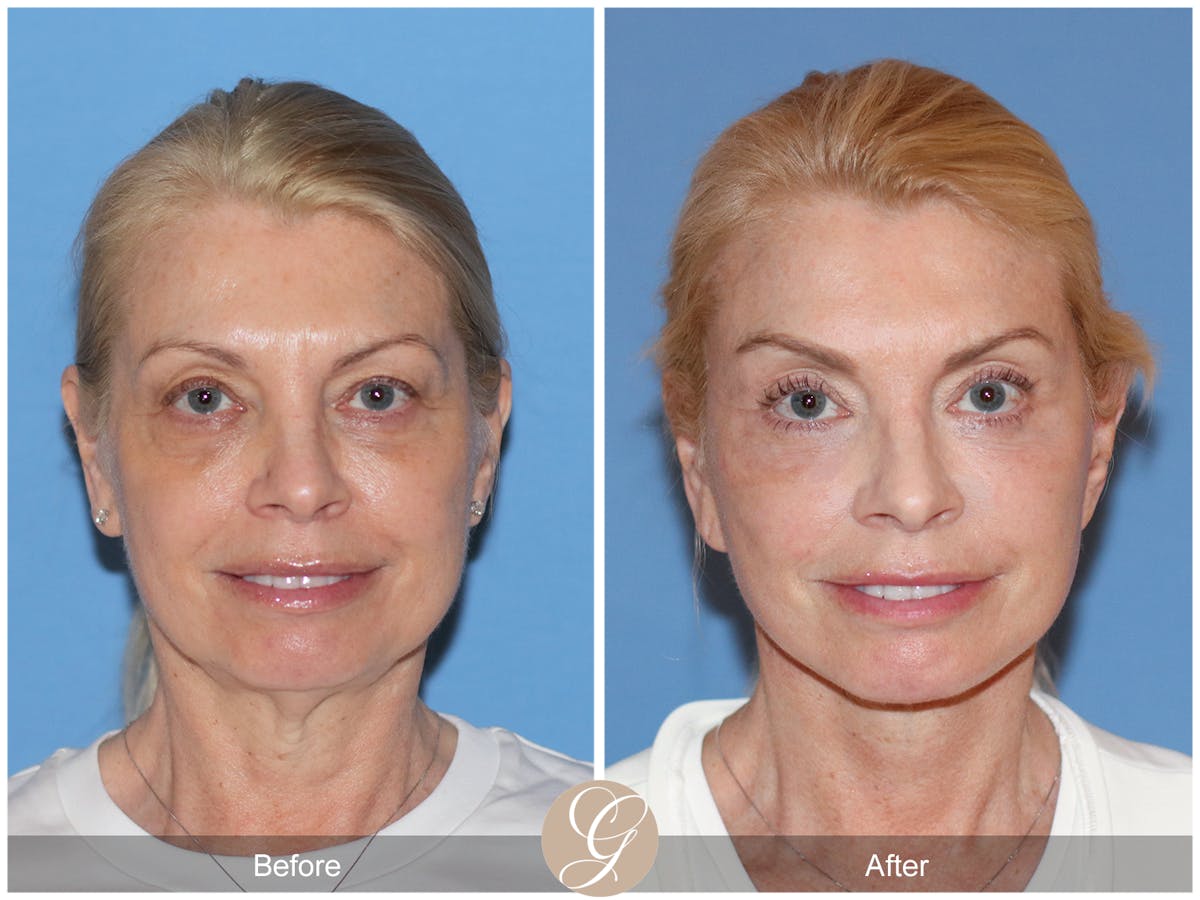 Preservation Facelift Before & After Gallery - Patient 306280 - Image 2