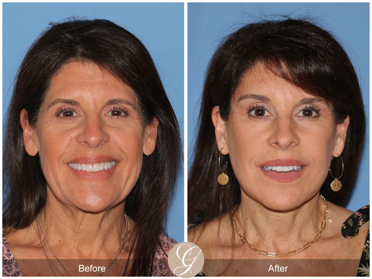 Deep Plane Facelift Before & After Gallery - Patient 389049 - Image 2