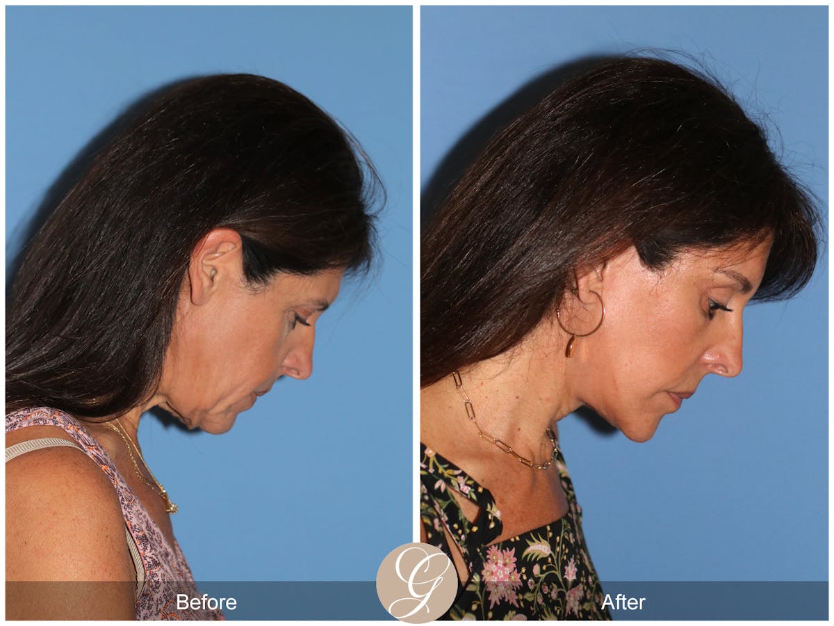 Deep Plane Facelift Before & After Gallery - Patient 389049 - Image 7