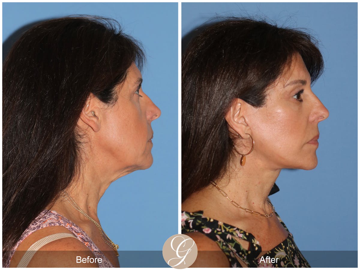 Deep Plane Facelift Before & After Gallery - Patient 389049 - Image 6