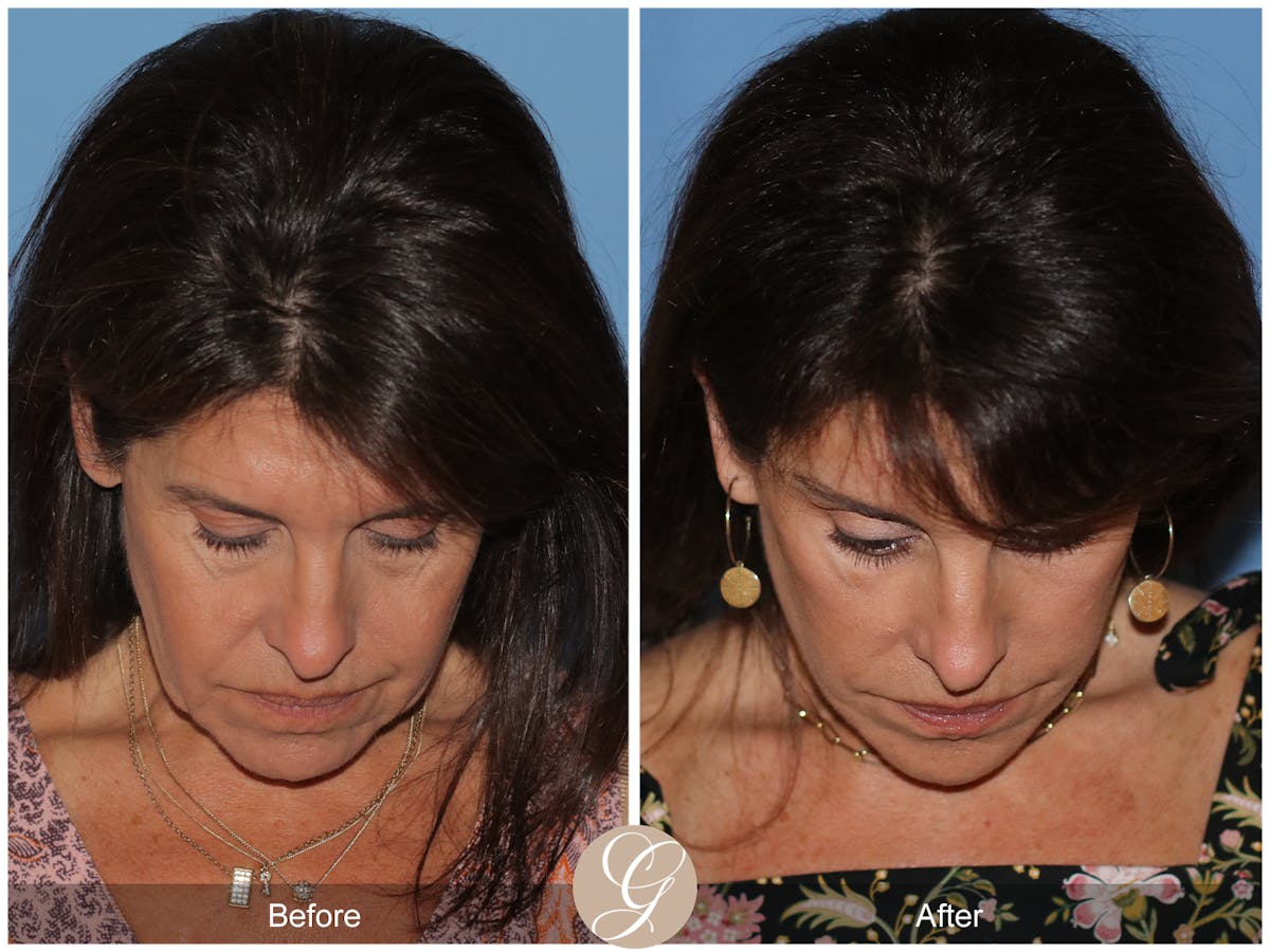 Deep Plane Facelift Before & After Gallery - Patient 389049 - Image 3