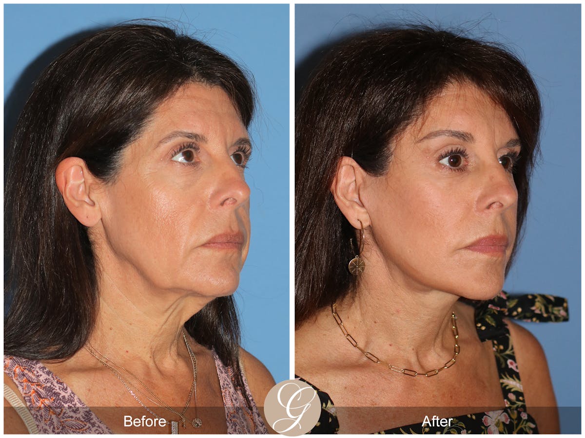 Deep Plane Facelift Before & After Gallery - Patient 389049 - Image 4