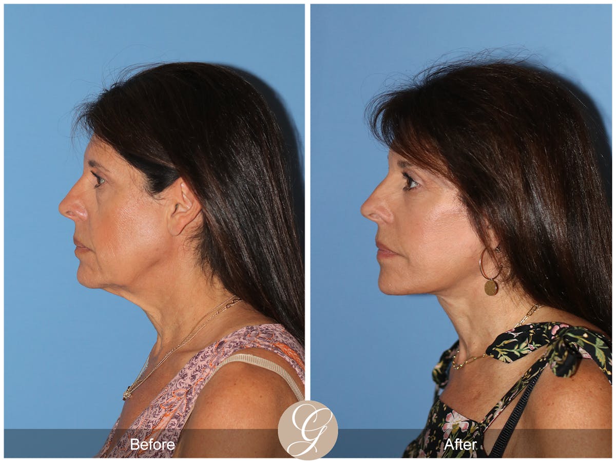 Deep Plane Facelift Before & After Gallery - Patient 389049 - Image 10