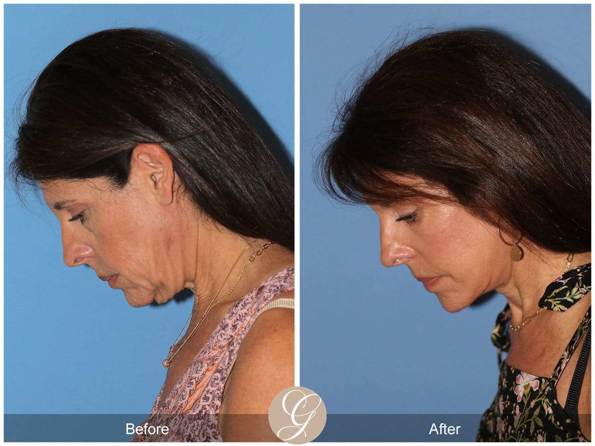 Deep Plane Facelift Before & After Gallery - Patient 389049 - Image 11