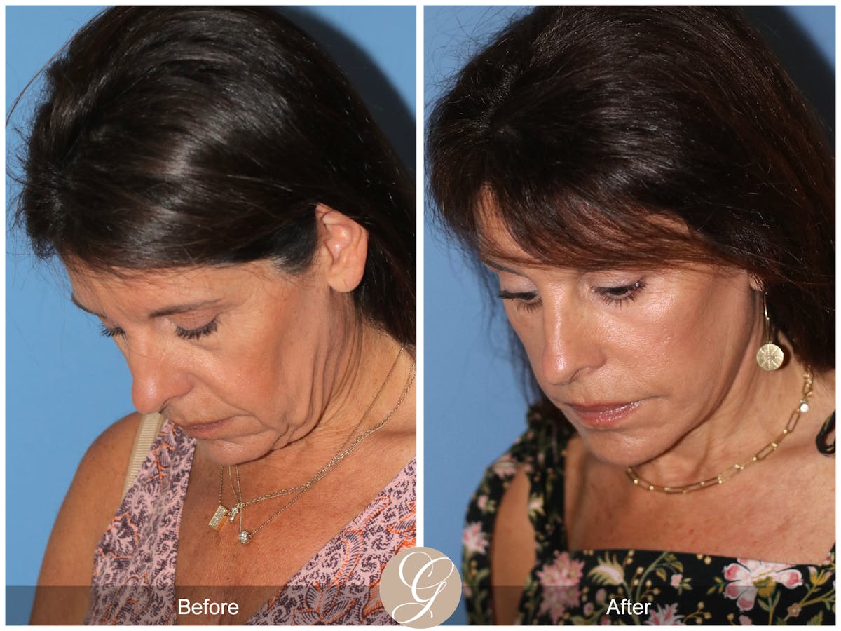 Deep Plane Facelift Before & After Gallery - Patient 389049 - Image 9