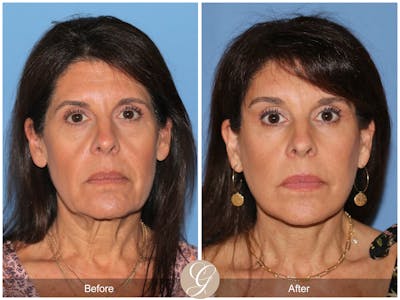 Deep Plane Facelift Before & After Gallery - Patient 389049 - Image 1