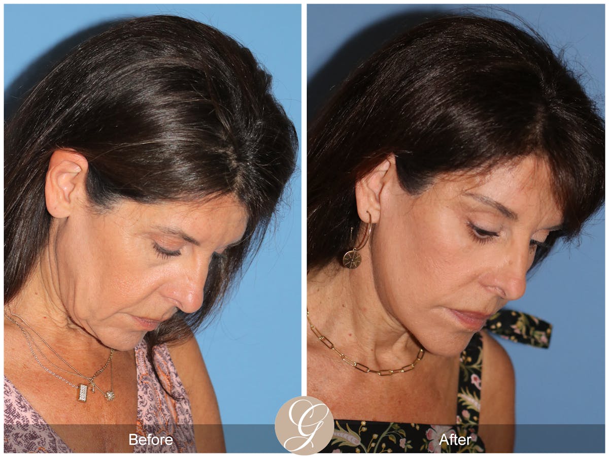 Deep Plane Facelift Before & After Gallery - Patient 389049 - Image 5