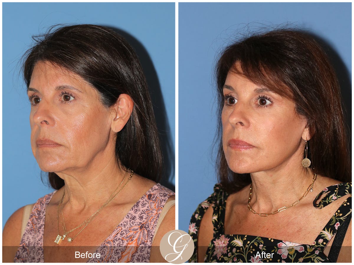 Deep Plane Facelift Before & After Gallery - Patient 389049 - Image 8