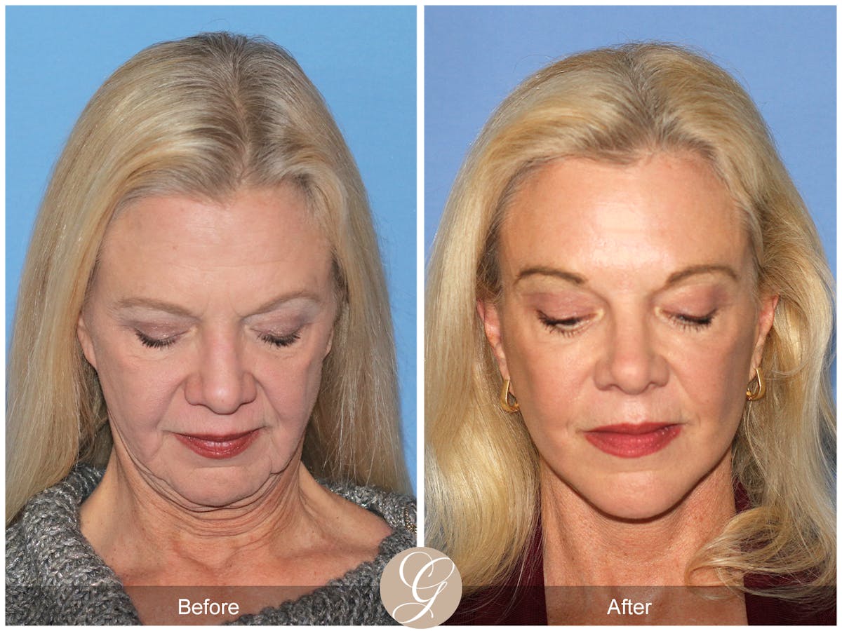 Deep Plane Facelift Before & After Gallery - Patient 136753 - Image 3