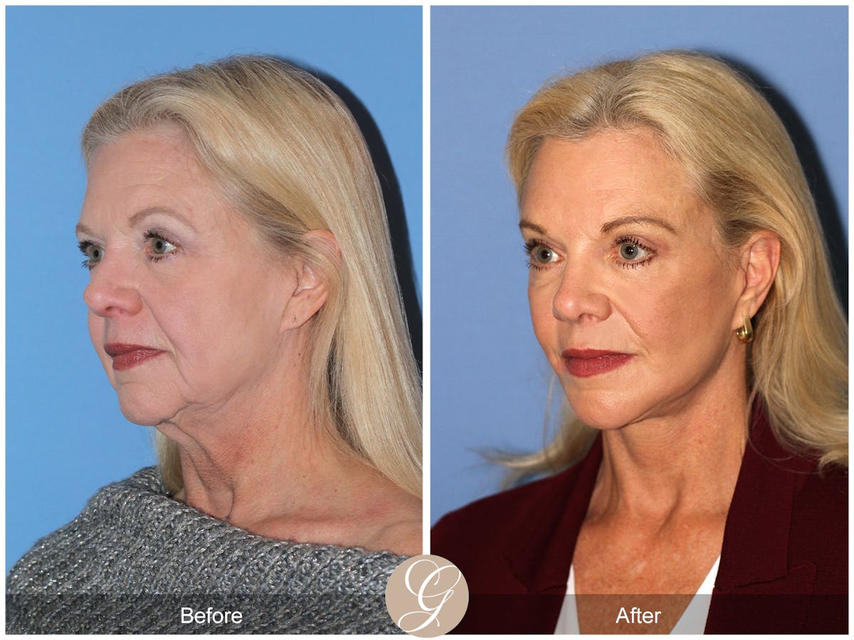 Deep Plane Facelift Before & After Gallery - Patient 136753 - Image 8