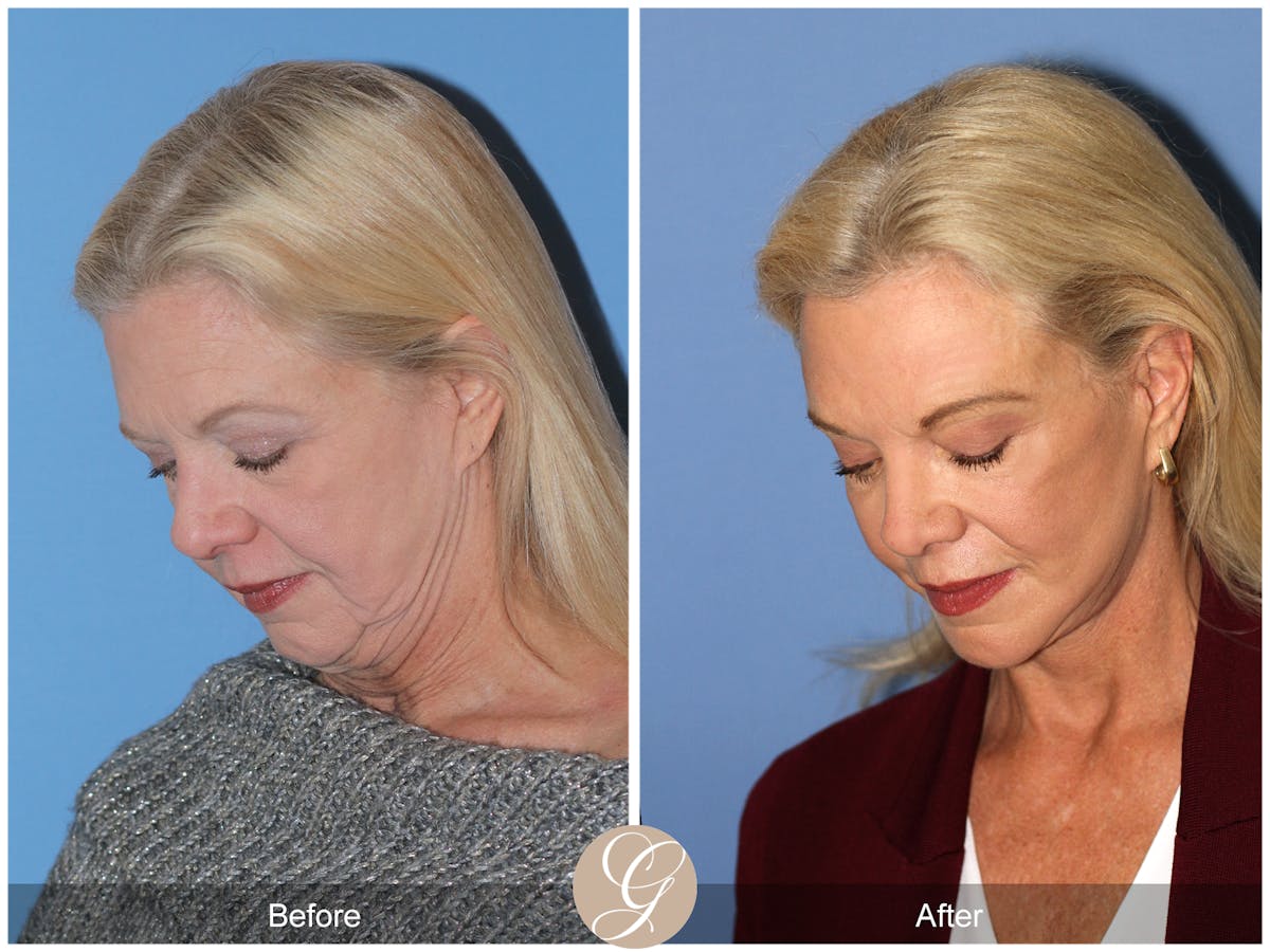 Deep Plane Facelift Before & After Gallery - Patient 136753 - Image 9