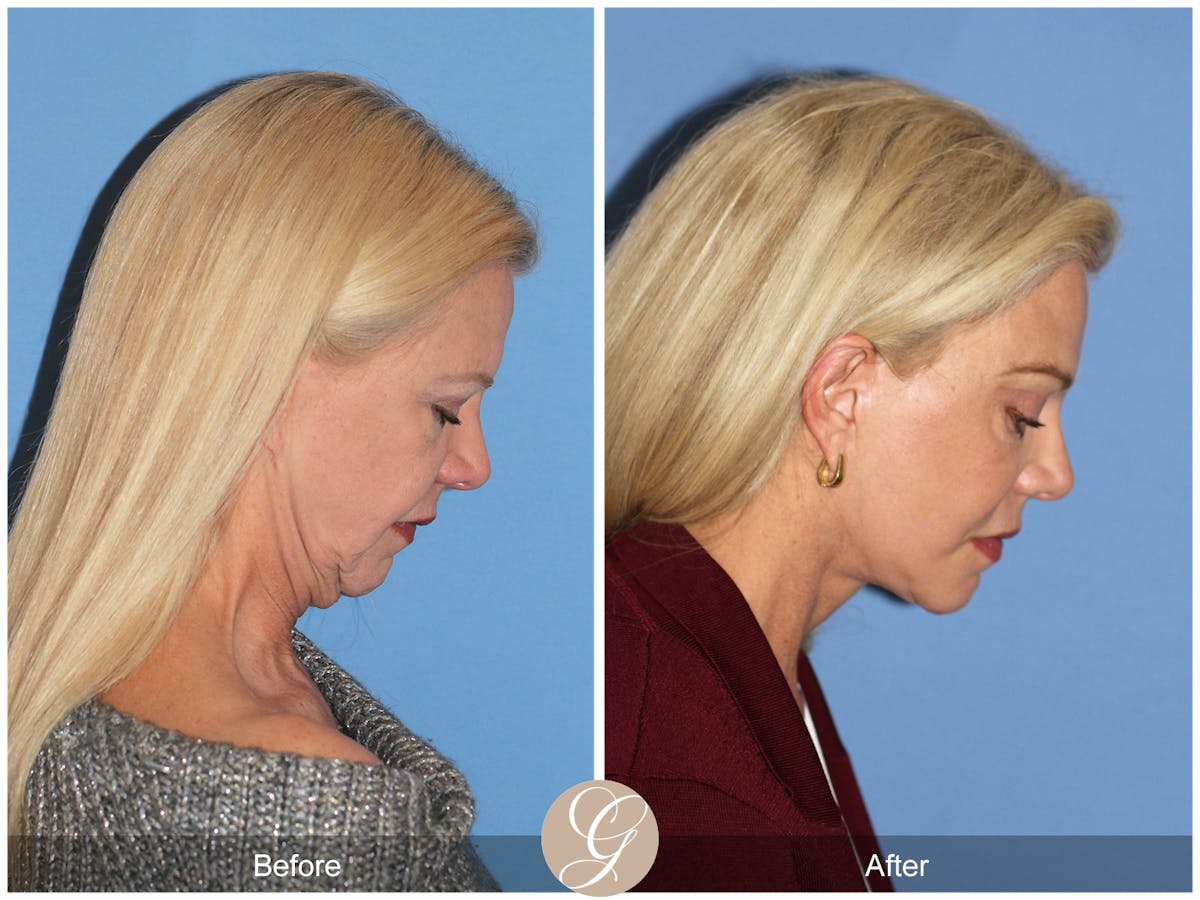 Deep Plane Facelift Before & After Gallery - Patient 136753 - Image 7