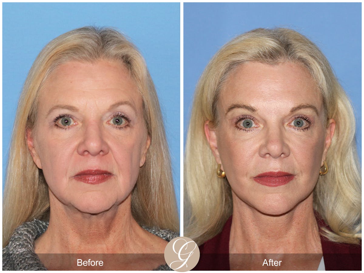 Deep Plane Facelift Before & After Gallery - Patient 136753 - Image 1