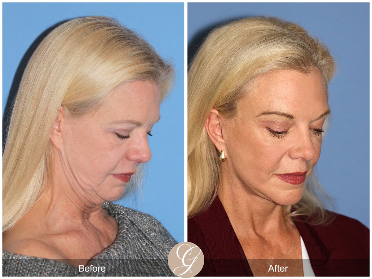 Deep Plane Facelift Before & After Gallery - Patient 136753 - Image 5