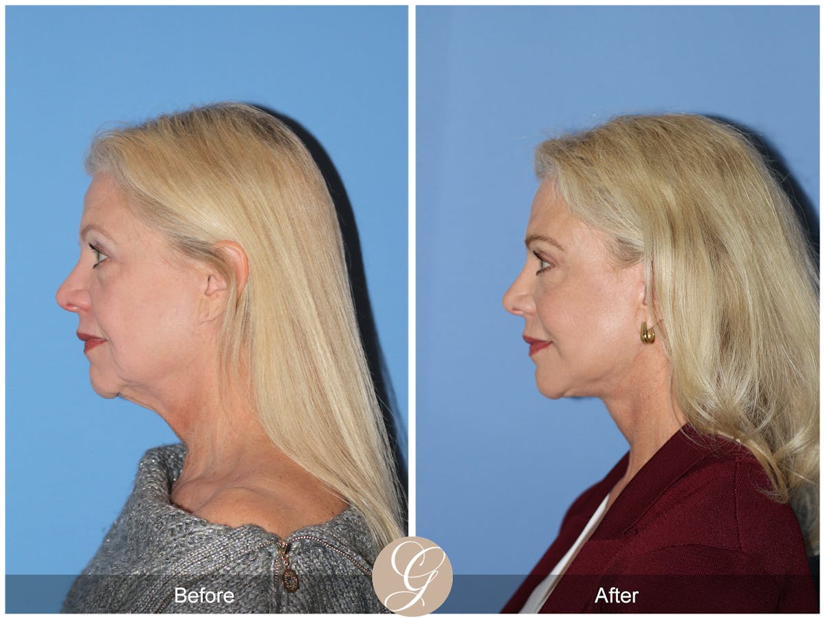 Deep Plane Facelift Before & After Gallery - Patient 136753 - Image 10