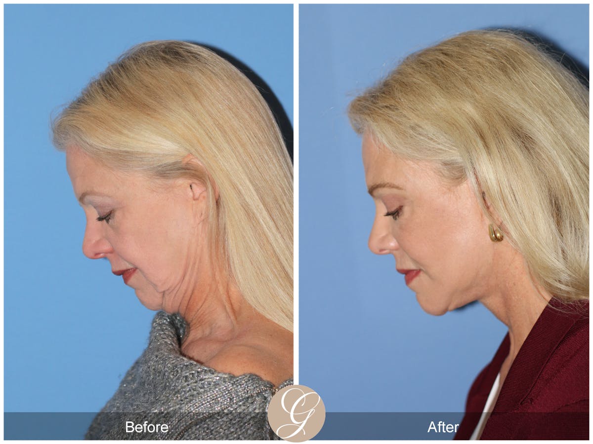 Deep Plane Facelift Before & After Gallery - Patient 136753 - Image 11