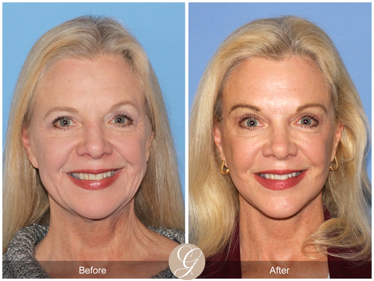 Deep Plane Facelift Before & After Gallery - Patient 136753 - Image 2