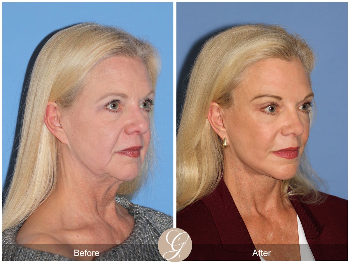 Deep Plane Facelift Before & After Gallery - Patient 136753 - Image 4