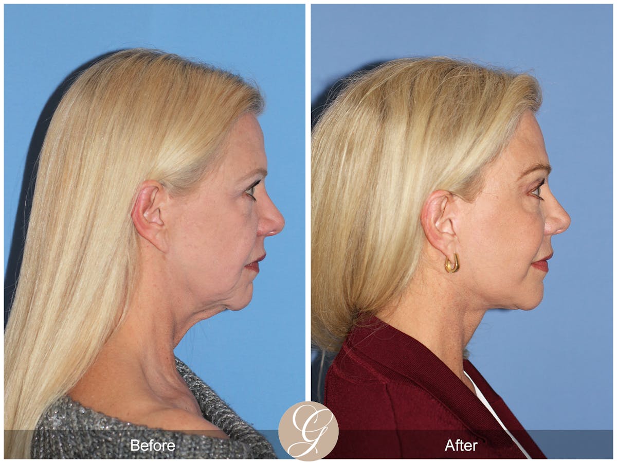 Deep Plane Facelift Before & After Gallery - Patient 136753 - Image 6