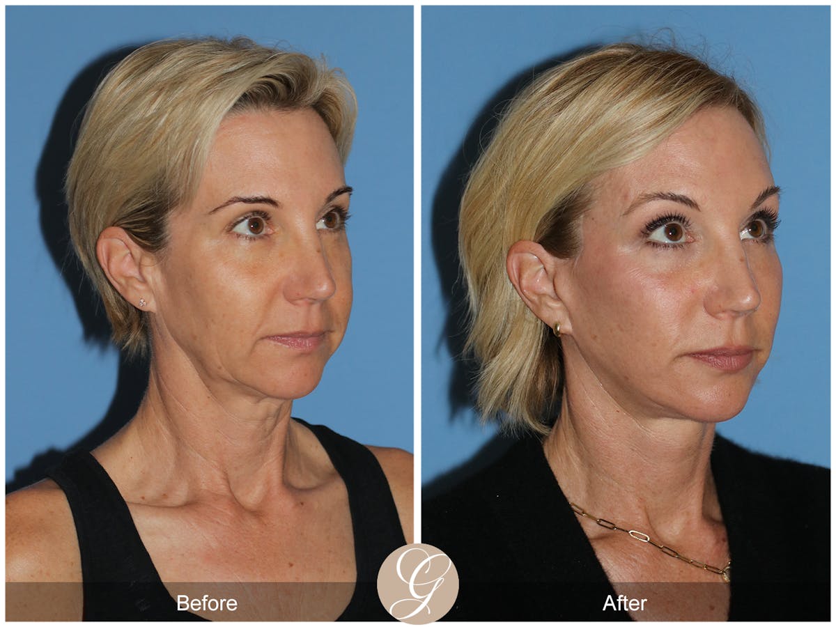 Deep Plane Facelift Before & After Gallery - Patient 252168 - Image 4