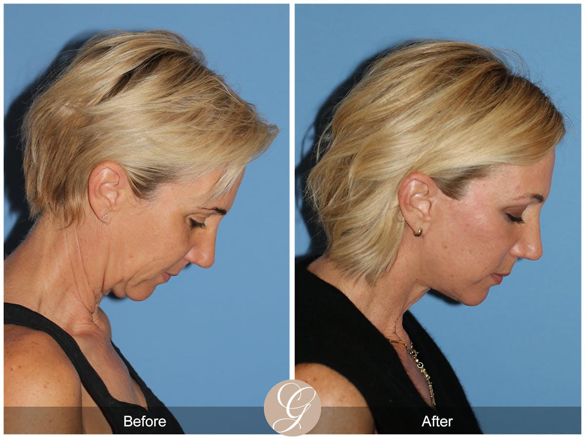 Deep Plane Facelift Before & After Gallery - Patient 252168 - Image 7