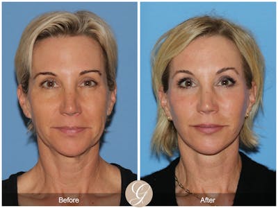 Deep Plane Facelift Before & After Gallery - Patient 252168 - Image 1
