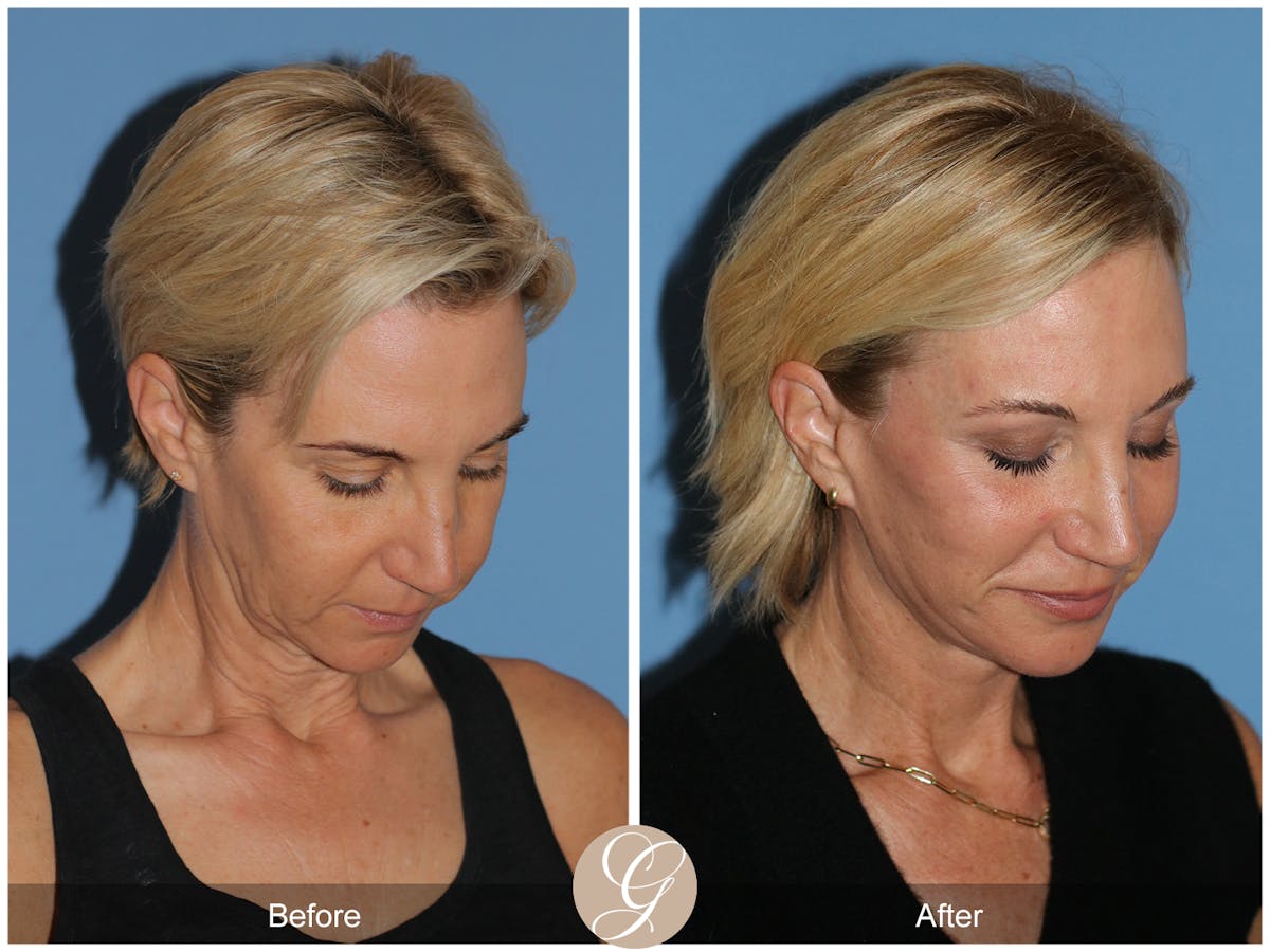 Deep Plane Facelift Before & After Gallery - Patient 252168 - Image 5