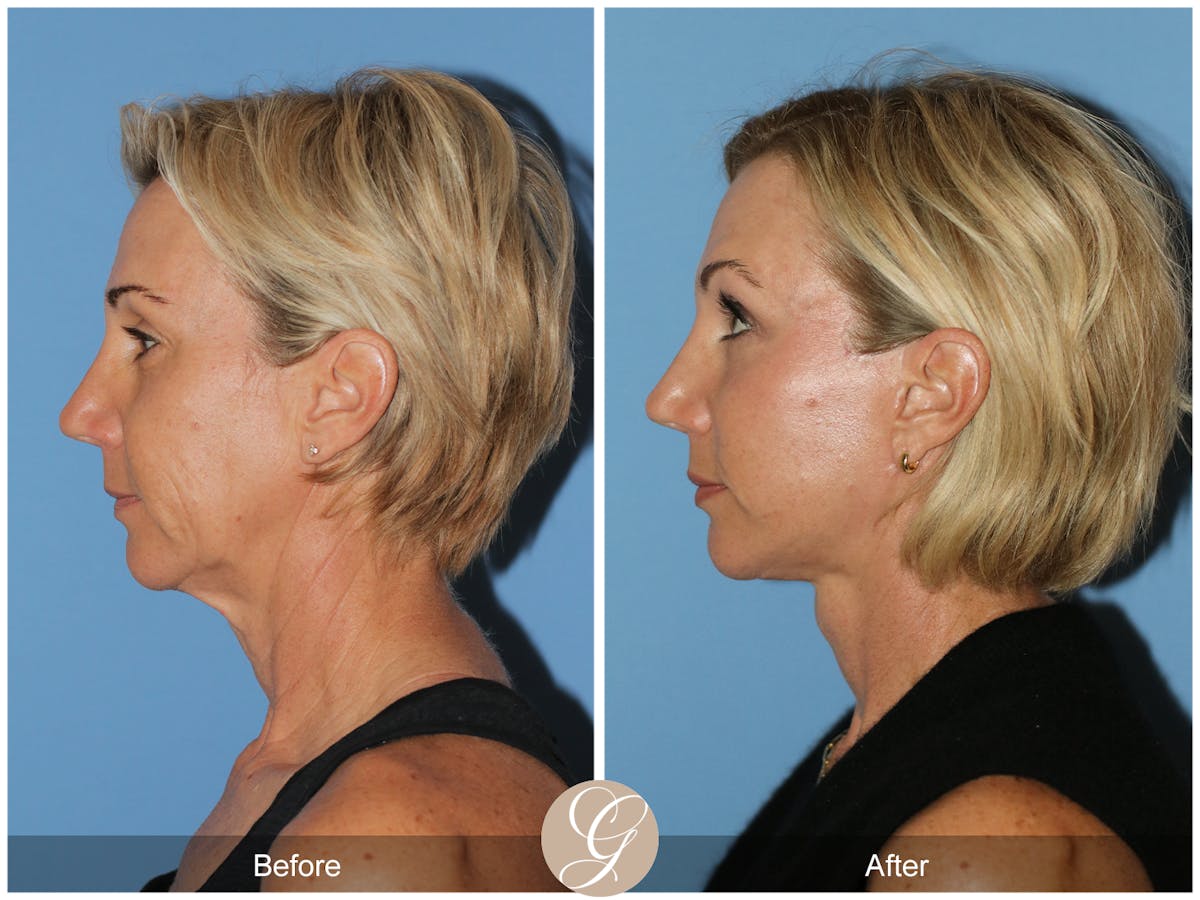Before and After Facelift and Neck Lift