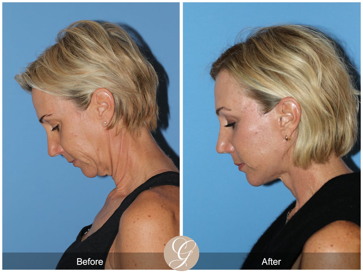 Deep Plane Facelift Before & After Gallery - Patient 252168 - Image 10