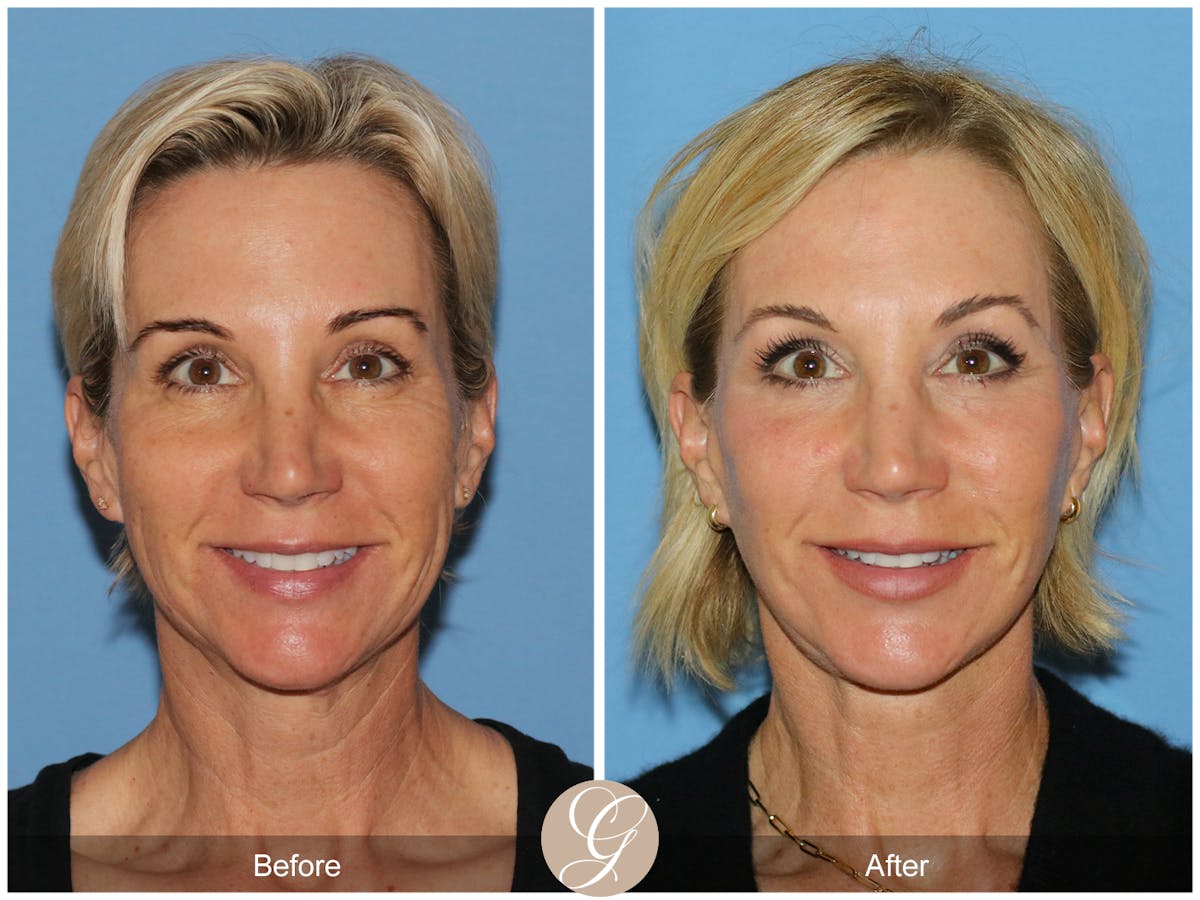 Deep Plane Facelift Before & After Gallery - Patient 252168 - Image 2