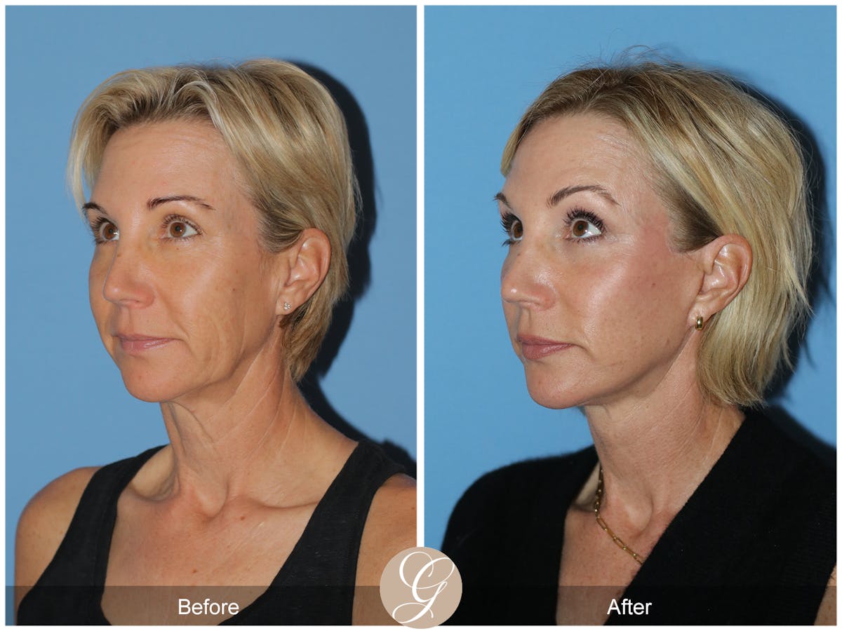 Deep Plane Facelift Before & After Gallery - Patient 252168 - Image 8