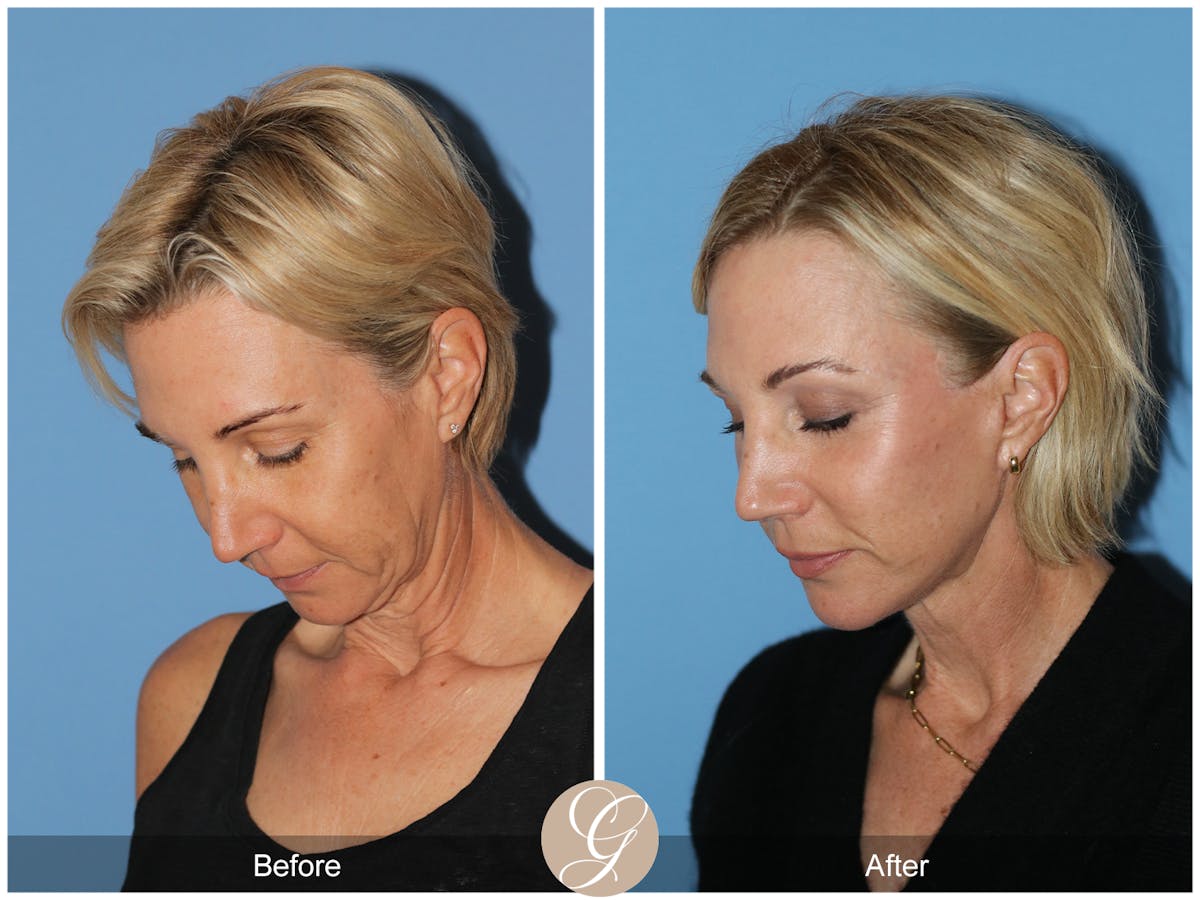 Deep Plane Facelift Before & After Gallery - Patient 252168 - Image 9