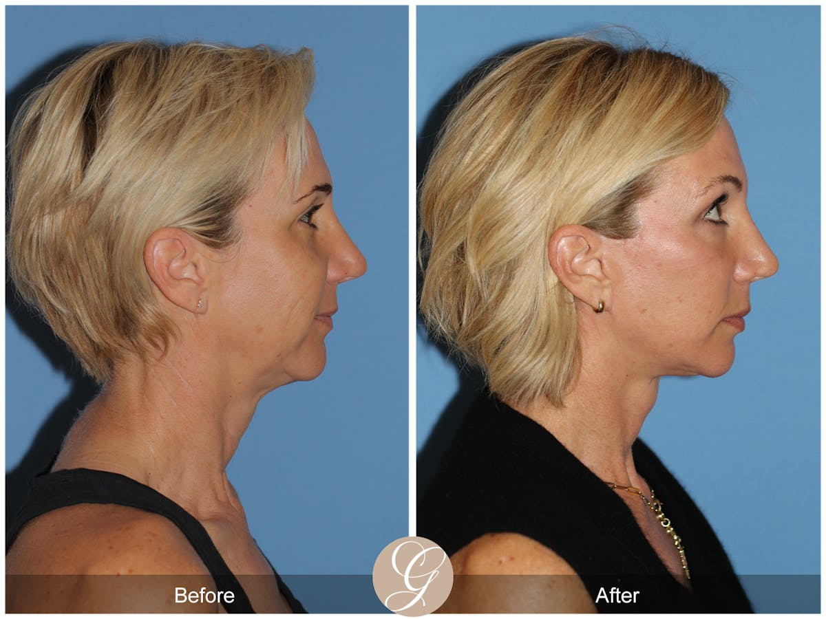 Deep Plane Facelift Before & After Gallery - Patient 252168 - Image 6