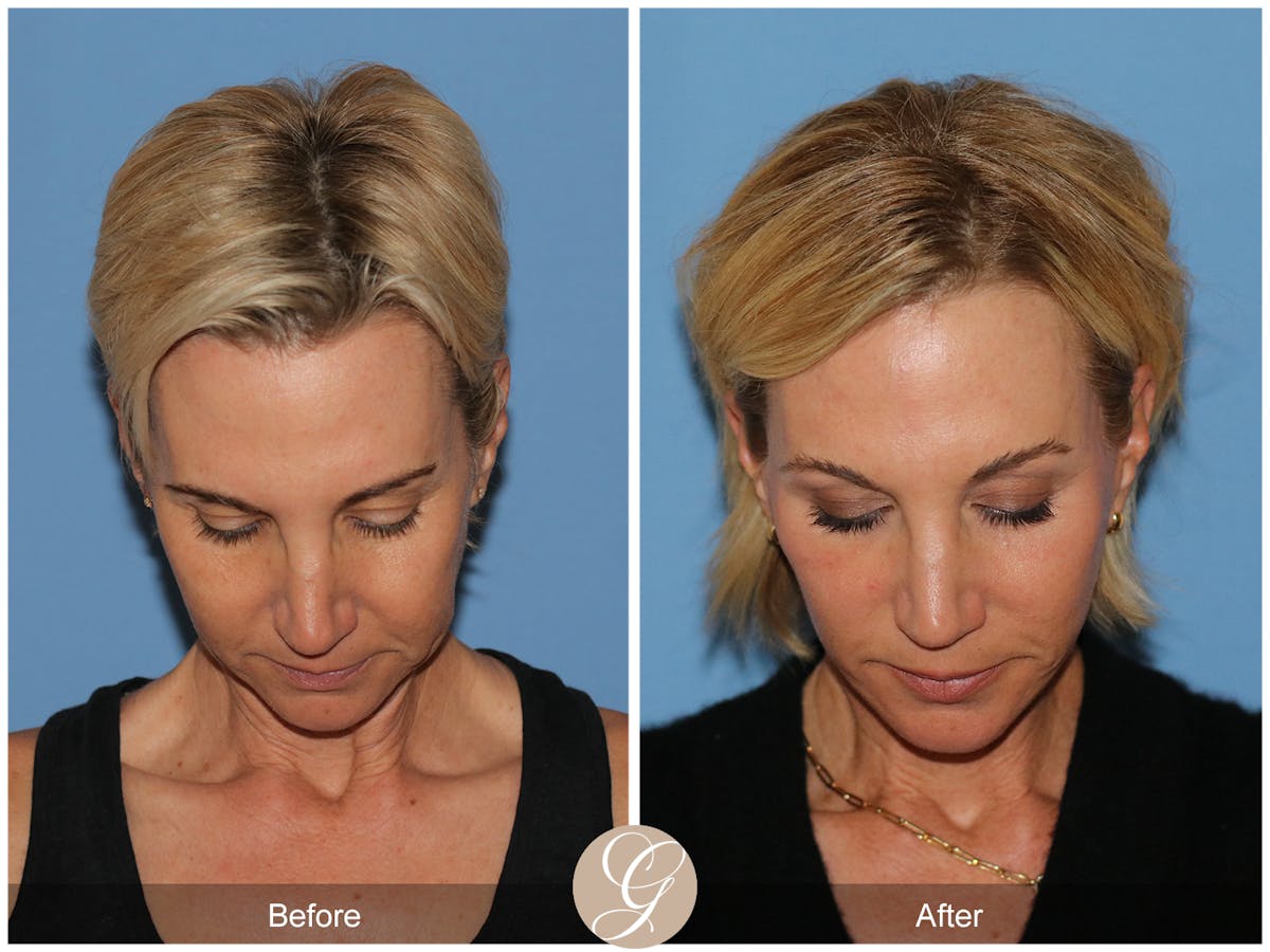 Deep Plane Facelift Before & After Gallery - Patient 252168 - Image 3
