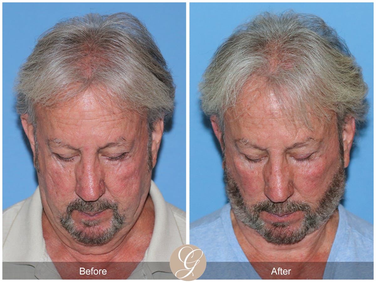 Deep Plane Facelift Before & After Gallery - Patient 322975 - Image 3