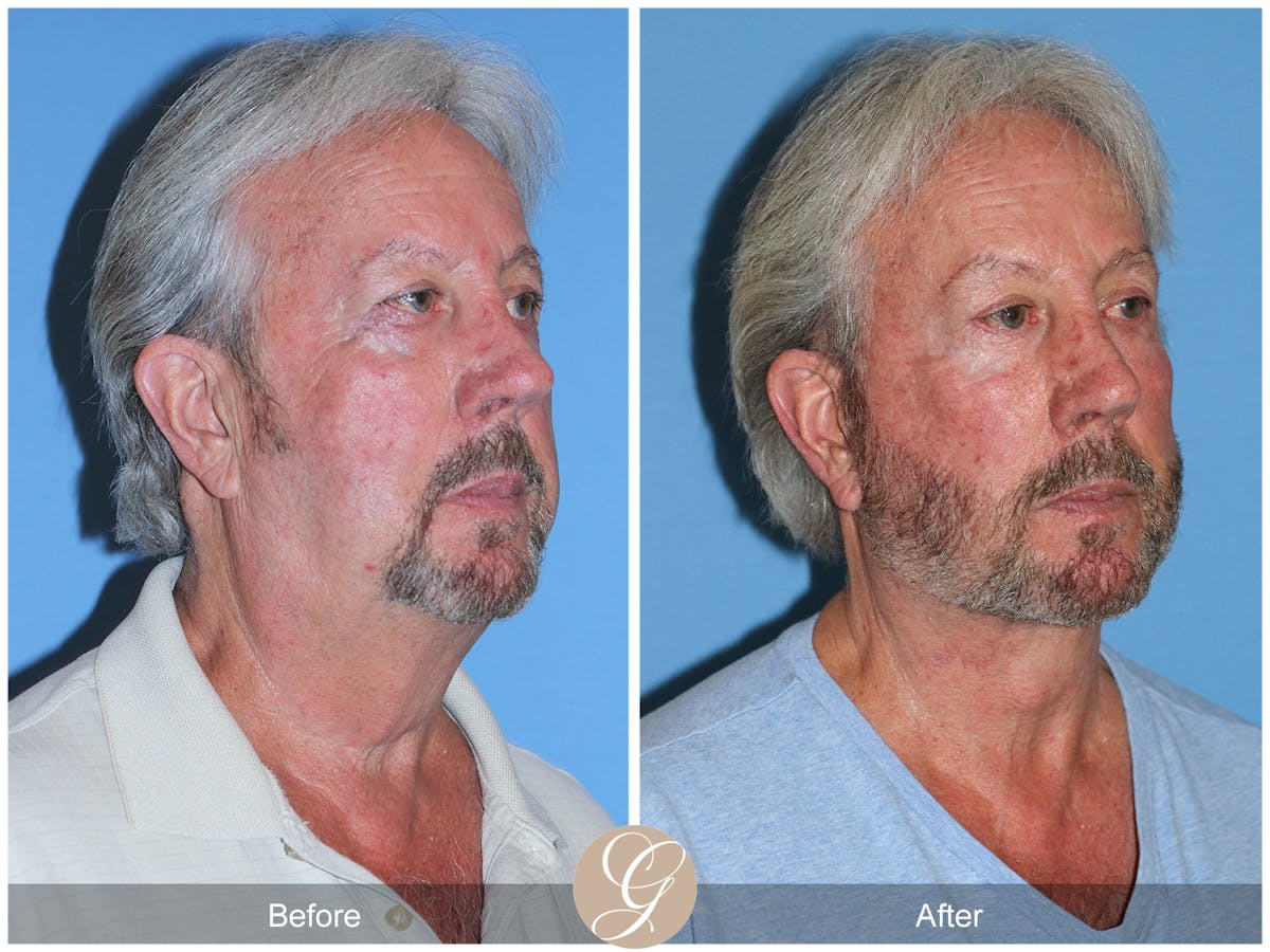 Deep Plane Facelift Before & After Gallery - Patient 322975 - Image 4