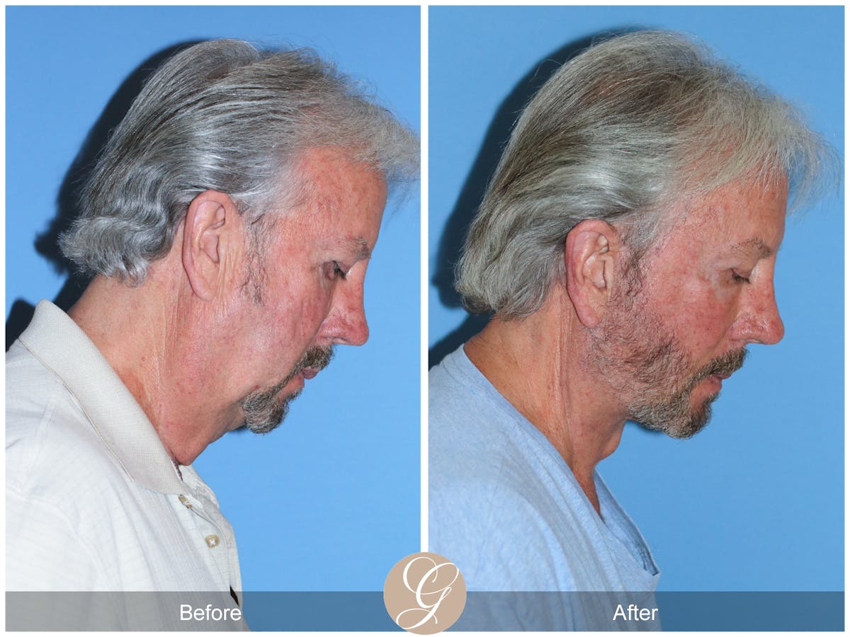 Deep Plane Facelift Before & After Gallery - Patient 322975 - Image 7