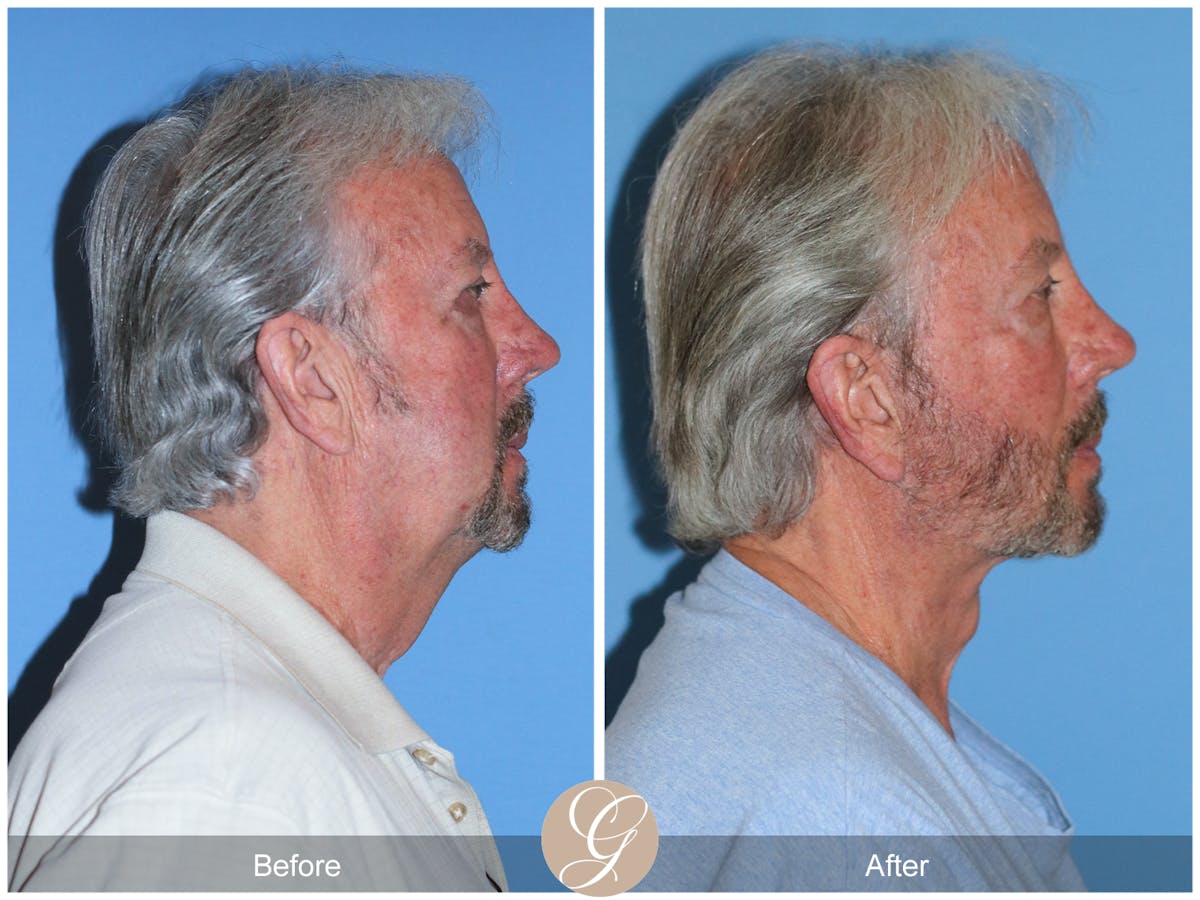 Deep Plane Facelift Before & After Gallery - Patient 322975 - Image 6
