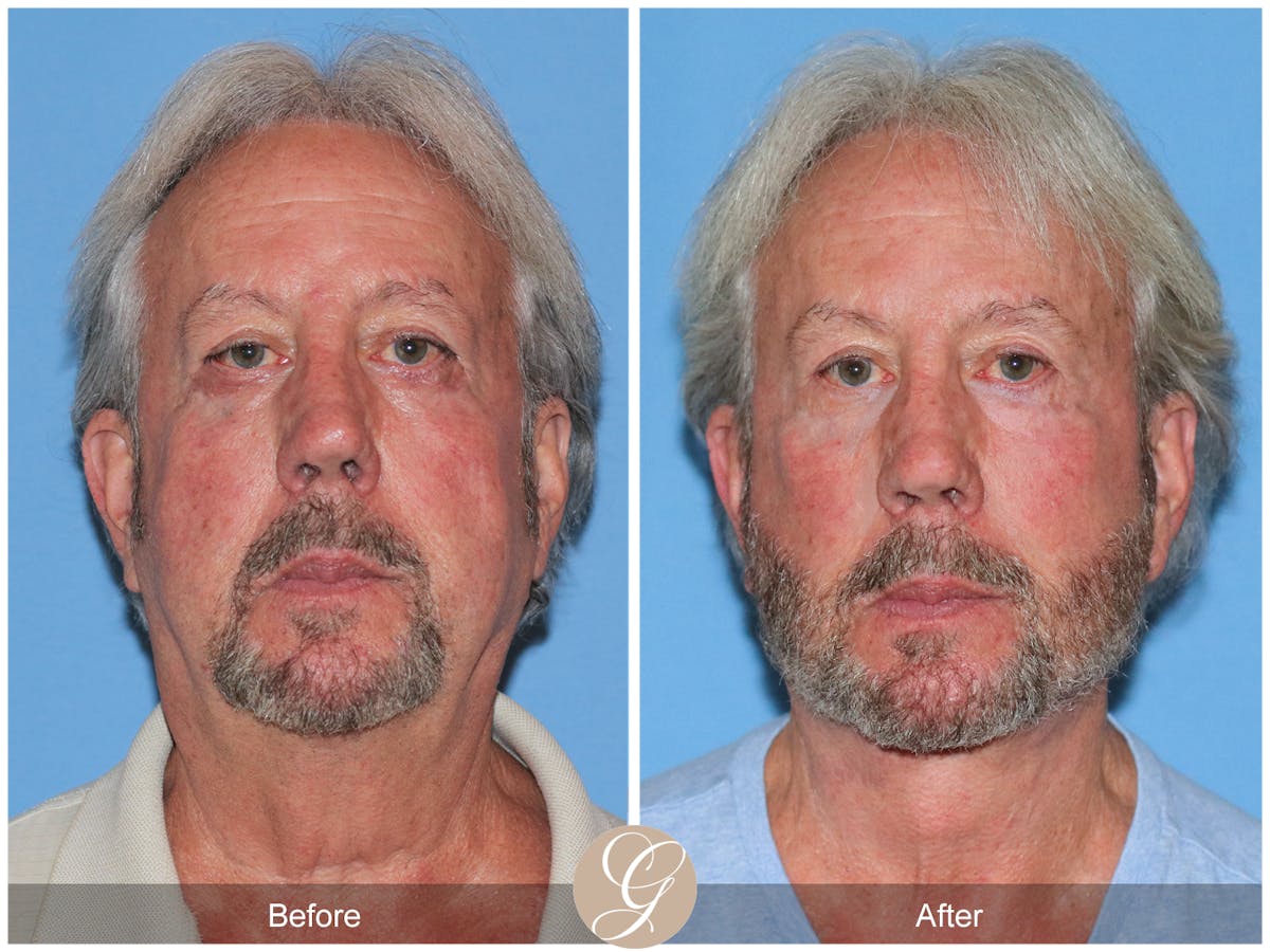 Deep Plane Facelift Before & After Gallery - Patient 322975 - Image 1