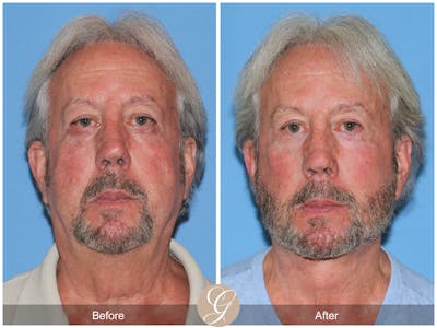 Deep Plane Facelift Before & After Gallery - Patient 322975 - Image 1