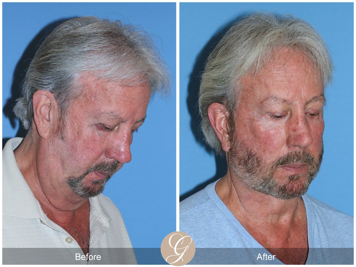 Deep Plane Facelift Before & After Gallery - Patient 322975 - Image 5