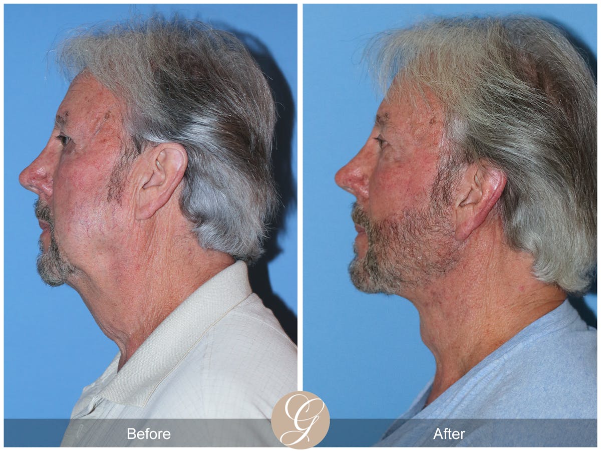 Deep Plane Facelift Before & After Gallery - Patient 322975 - Image 9