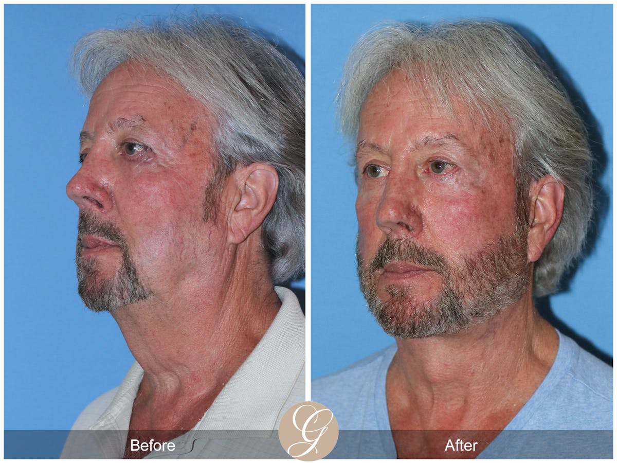 Deep Plane Facelift Before & After Gallery - Patient 322975 - Image 8