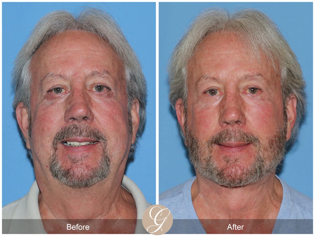 Deep Plane Facelift Before & After Gallery - Patient 322975 - Image 2